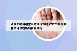 紅皮型銀屑病查血可以吃飯嗎 紅皮型銀屑病查血可以吃飯嗎有影響嗎