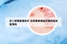點滳狀銀屑病光療 點狀銀屑病治療期間會反復發(fā)嗎