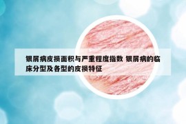 銀屑病皮損面積與嚴(yán)重程度指數(shù) 銀屑病的臨床分型及各型的皮損特征
