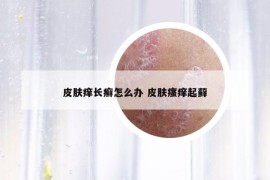 皮膚癢長癬怎么辦 皮膚瘙癢起蘚