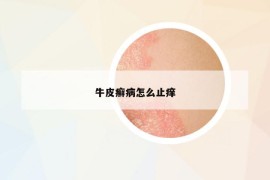 牛皮癬病怎么止癢
