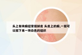 頭上有塊癬經(jīng)常摳掉皮 頭皮上的癬,一摳可以摳下來一塊白色的組織