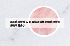 銀屑病活檢疼么 銀屑病做活體組織病理檢查準(zhǔn)確率是多少