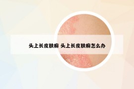 頭上長皮膚癬 頭上長皮膚癬怎么辦