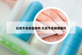 紅皮牛皮癬是癌嗎 紅皮牛皮膚癬圖片