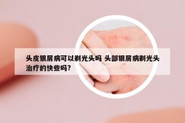 頭皮銀屑病可以剃光頭嗎 頭部銀屑病剃光頭治療的快些嗎?