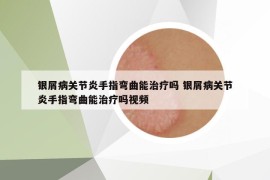 銀屑病關節(jié)炎手指彎曲能治療嗎 銀屑病關節(jié)炎手指彎曲能治療嗎視頻