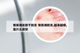 銀屑病皮膚干脫皮 銀屑病脫皮,越來(lái)越癢,是什么癥狀
