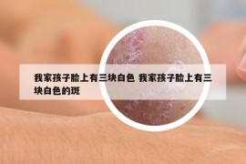 我家孩子臉上有三塊白色 我家孩子臉上有三塊白色的斑