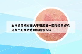 治療銀屑病鄭州大學(xué)附屬第一醫(yī)院效果好嗎 鄭大一附院治療銀屑病怎么樣