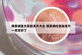 銀屑病復(fù)方氨肽素片大全 銀屑病吃氨肽素片一周見好了