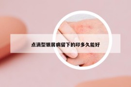 點滴型銀屑病留下的印多久能好
