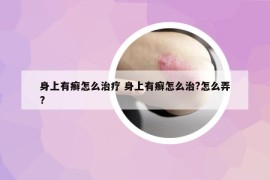 身上有癬怎么治療 身上有癬怎么治?怎么弄?