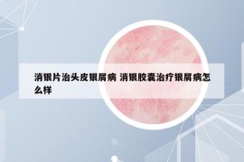 消銀片治頭皮銀屑病 消銀膠囊治療銀屑病怎么樣