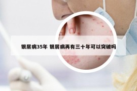 銀屑病35年 銀屑病再有三十年可以突破嗎