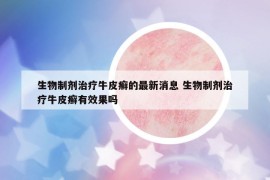 生物制劑治療牛皮癬的最新消息 生物制劑治療牛皮癬有效果嗎