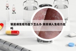 銀屑病免疫力低下怎么辦 銀屑病人免疫力低嗎