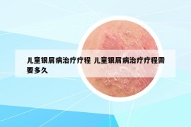 兒童銀屑病治療療程 兒童銀屑病治療療程需要多久