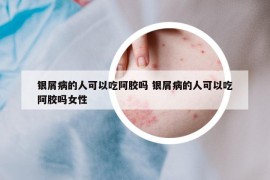 銀屑病的人可以吃阿膠嗎 銀屑病的人可以吃阿膠嗎女性