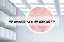 銀屑病有效的治療方法 銀屑病怎么治療有效