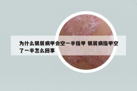 為什么銀屑病甲會(huì)空一半指甲 銀屑病指甲空了一半怎么回事