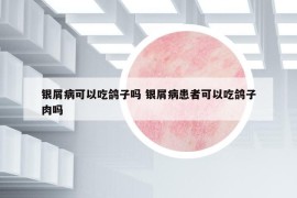 銀屑病可以吃鴿子嗎 銀屑病患者可以吃鴿子肉嗎