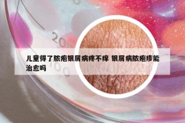 兒童得了膿皰銀屑病疼不癢 銀屑病膿皰疹能治愈嗎
