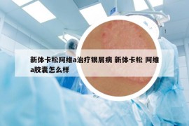 新體卡松阿維a治療銀屑病 新體卡松 阿維a膠囊怎么樣