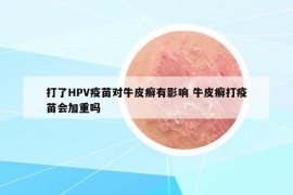 打了HPV疫苗對(duì)牛皮癬有影響 牛皮癬打疫苗會(huì)加重嗎