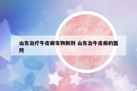 山東治療牛皮癬生物制劑 山東治牛皮癬的醫(yī)院