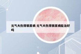 元?dú)獯髠勉y屑病 元?dú)獯髠勉y屑病能治好嗎