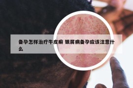 備孕怎樣治療牛皮癬 銀屑病備孕應(yīng)該注意什么