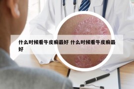 什么時候看牛皮癬最好 什么時候看牛皮癬最好