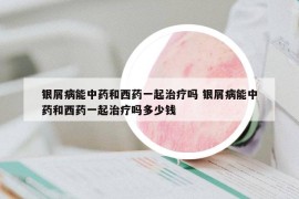 銀屑病能中藥和西藥一起治療嗎 銀屑病能中藥和西藥一起治療嗎多少錢