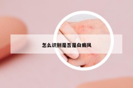 怎么識別是否是白癜風