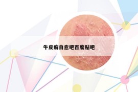 牛皮癬自愈吧百度貼吧