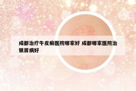 成都治療牛皮癬醫(yī)院哪家好 成都哪家醫(yī)院治銀屑病好
