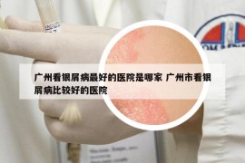 廣州看銀屑病最好的醫(yī)院是哪家 廣州市看銀屑病比較好的醫(yī)院