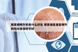 銀屑病喝牛奶有什么好處 銀屑病患者能喝牛奶嗎對身體好不好