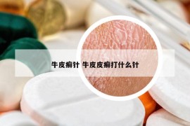 牛皮癬針 牛皮皮癬打什么針