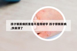 孩子銀屑病厲害是不是得修學(xué) 孩子得銀屑病,快崩潰了