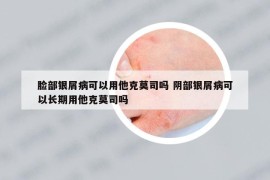 臉部銀屑病可以用他克莫司嗎 陰部銀屑病可以長(zhǎng)期用他克莫司嗎