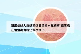 銀屑病進(jìn)入消退期還長很多小紅疙瘩 銀屑病在消退期為啥還長小疹子