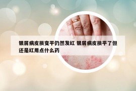 銀屑病皮損變平仍然發(fā)紅 銀屑病皮損平了但還是紅用點什么藥