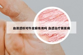血液透析對(duì)牛皮癬有用嗎 血透治療銀屑病