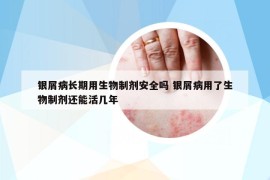 銀屑病長(zhǎng)期用生物制劑安全嗎 銀屑病用了生物制劑還能活幾年