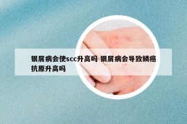 銀屑病會使scc升高嗎 銀屑病會導致鱗癌抗原升高嗎