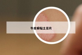 牛皮癬貼土豆片