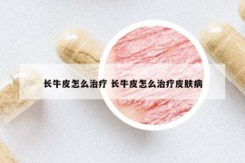長牛皮怎么治療 長牛皮怎么治療皮膚病