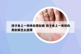 孩子身上一塊塊白類似癬 孩子身上一塊塊白類似癬怎么回事